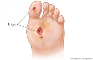 Foot Wound or Ulcer